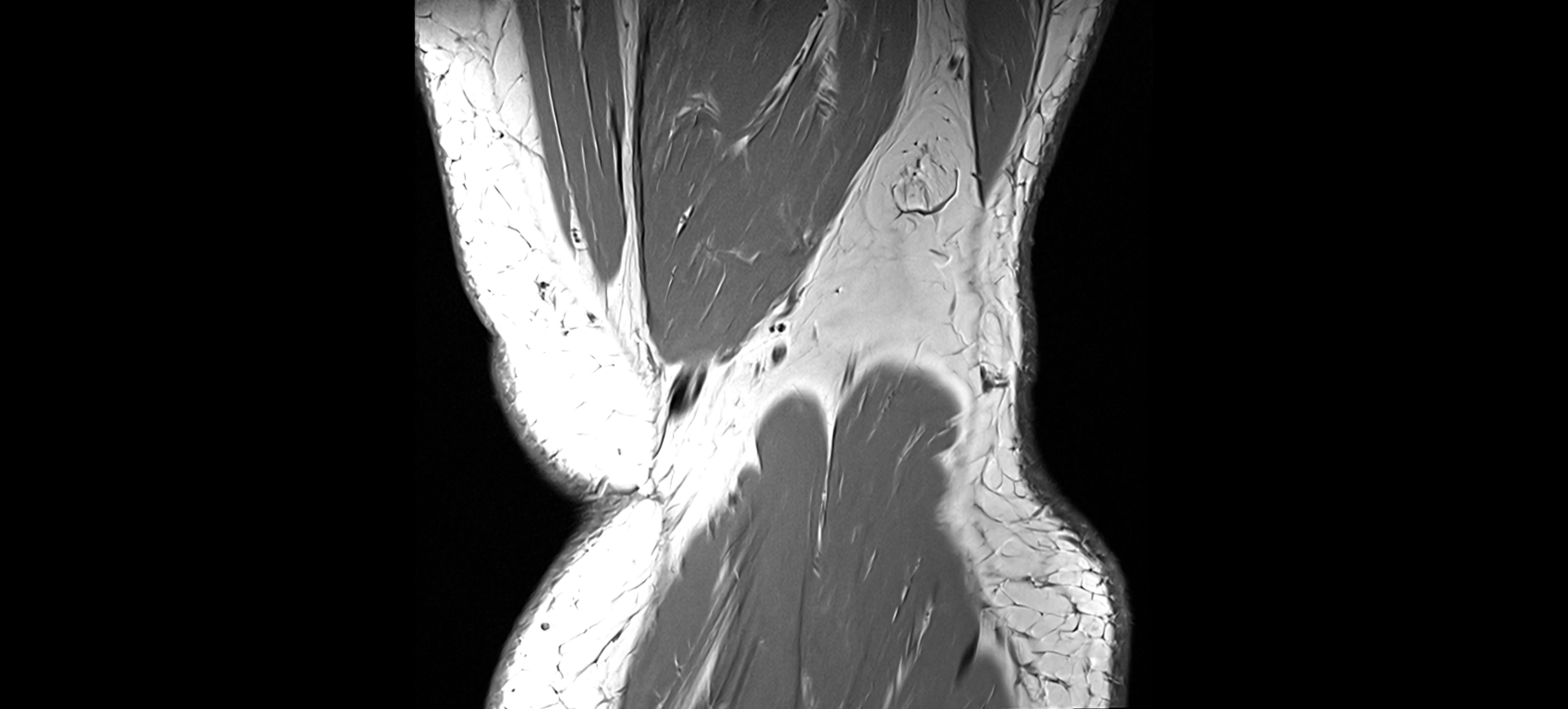 MRI coronal  ligaments cross sectional anatomy 3T  radiology  image-img-04001-00041.webp